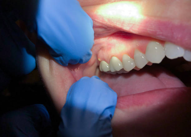 Best Emergency Gum Treatment in Melcher Dallas, IA