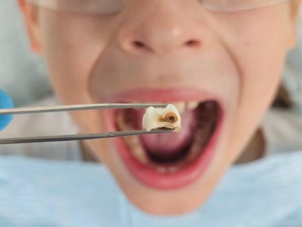Best Emergency Dental Care for Broken or Chipped Teeth in Melcher Dallas, IA